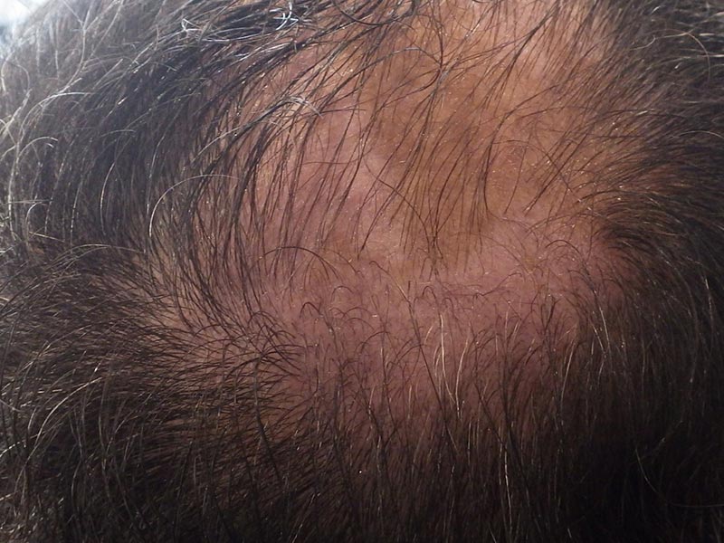 Traitement Repousse Cheveux