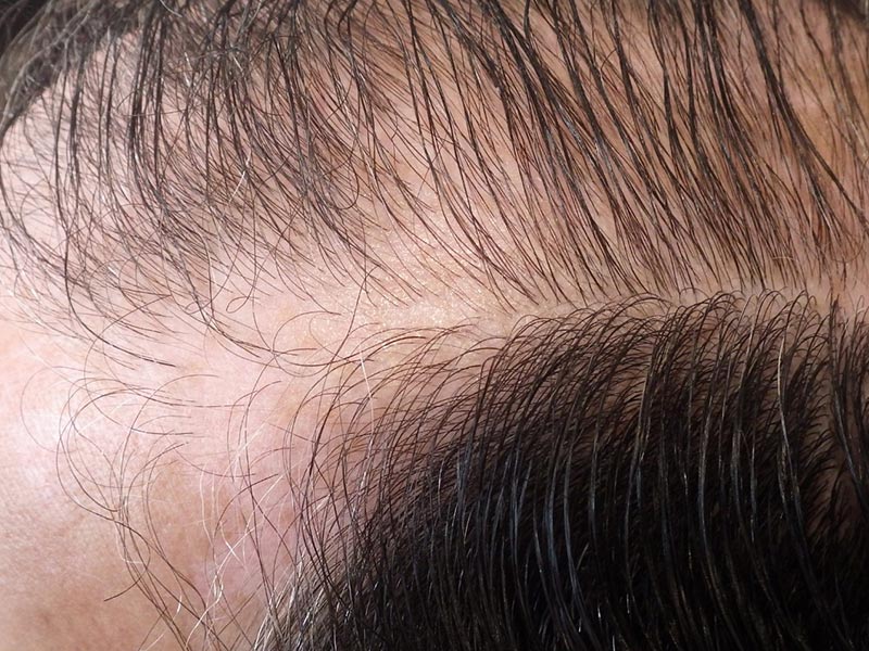 Traitement Repousse Cheveux