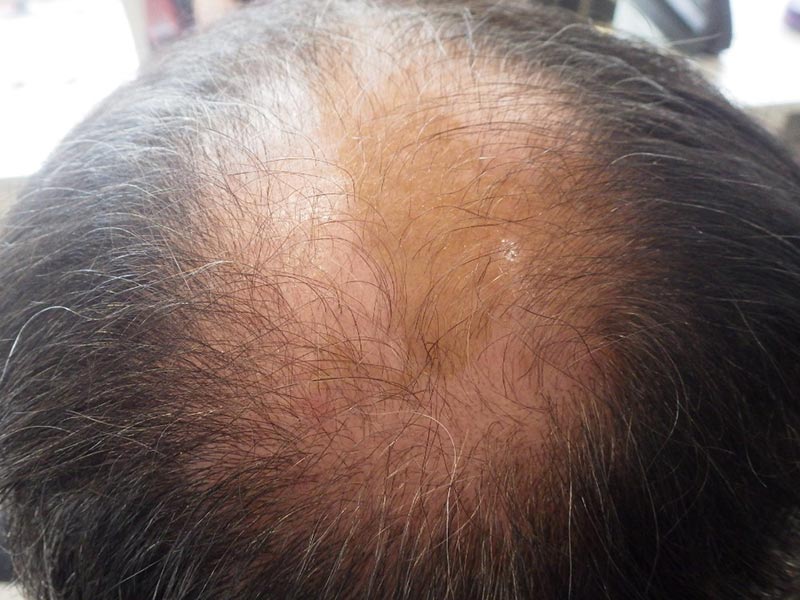 Traitement Repousse Cheveux