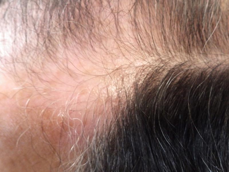 Traitement Repousse Cheveux