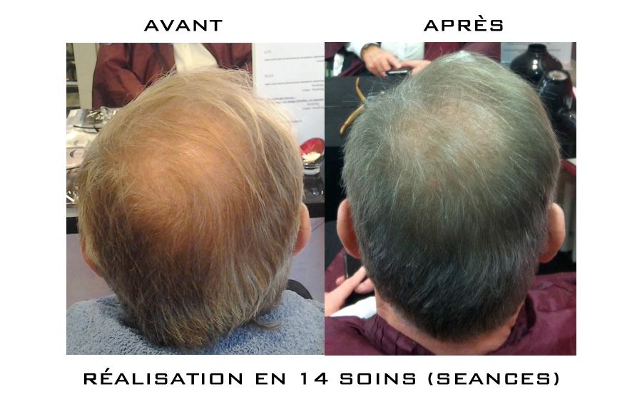 Chevelure en gros blanc pour démonstartion repousse de cheveux